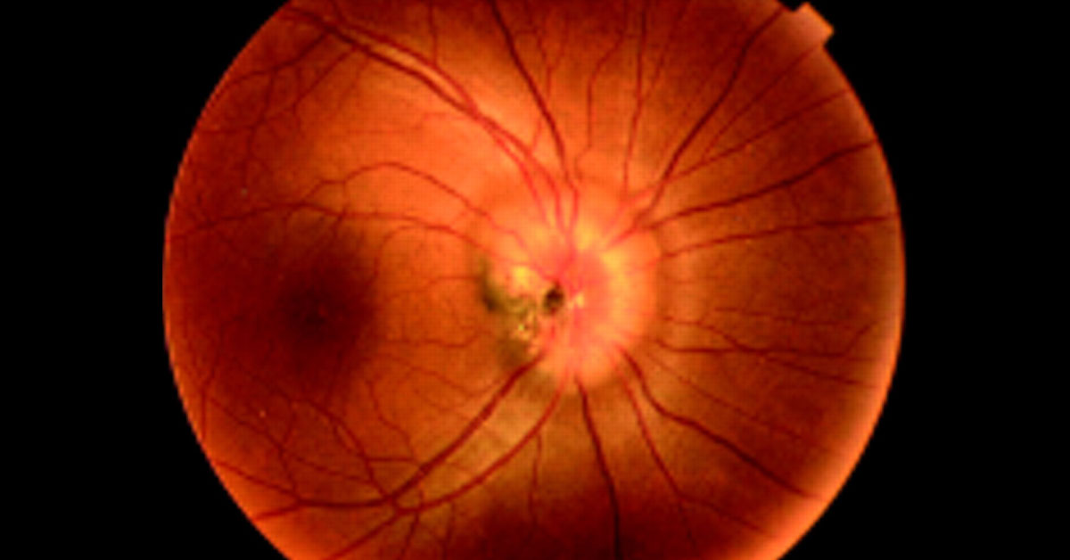 Retinal Complications Associated With Congenital Anomalies Of Discs