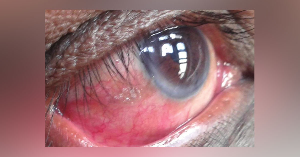 Brief Review On Ocular Manifestations Of Obesity