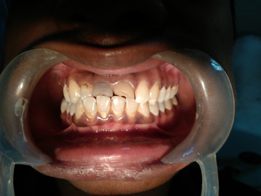 Fractured Tooth With Reduced Interocclusal Distance
