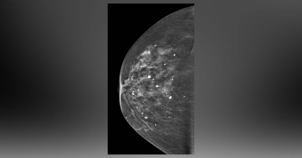 What is your inference from this Mammogram?