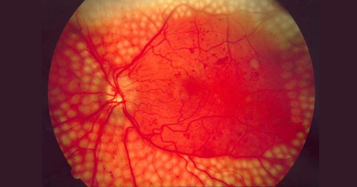 Very Brief Review On Indications Of Pan-Retinal Photo-Coagulation