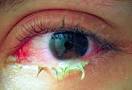 Brief Review On Ocular Manifestations Of Rickettsiosis