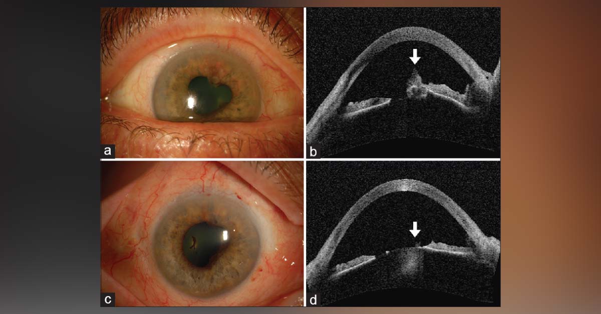 Brief Review On Ocular Complications Of Radiotherapy