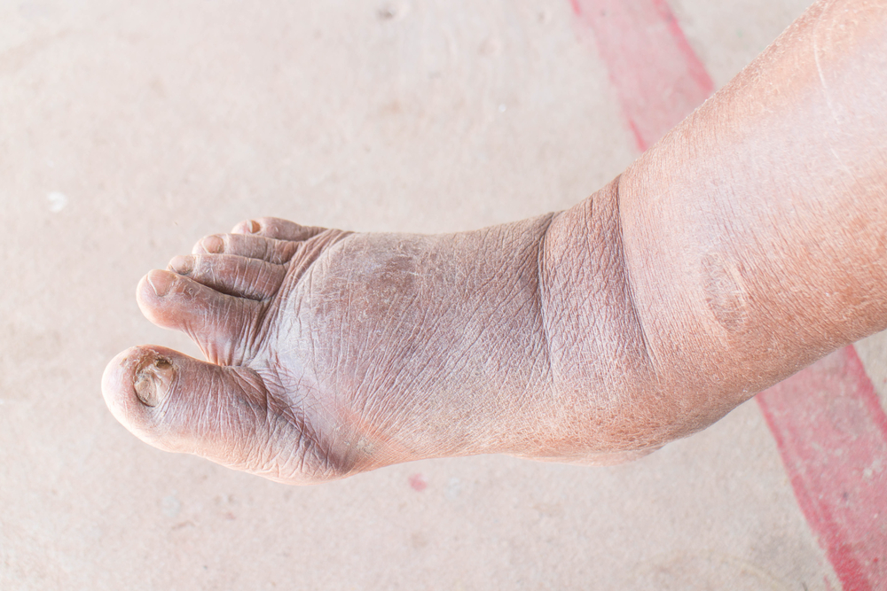 Diabetic Autonomic Neuropathy