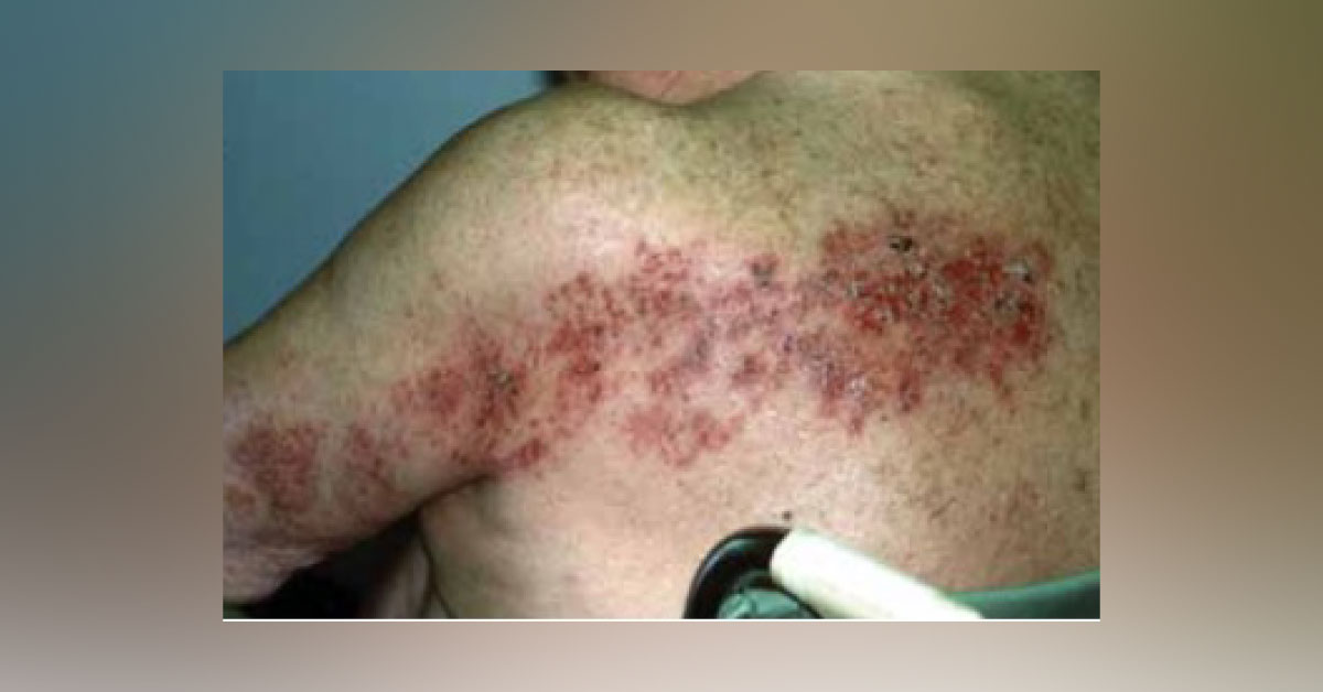 Identify the Skin Condition