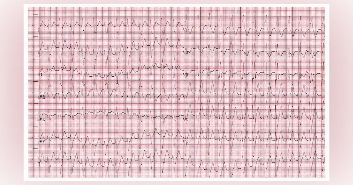 Can You Interpret These ECG Findings?