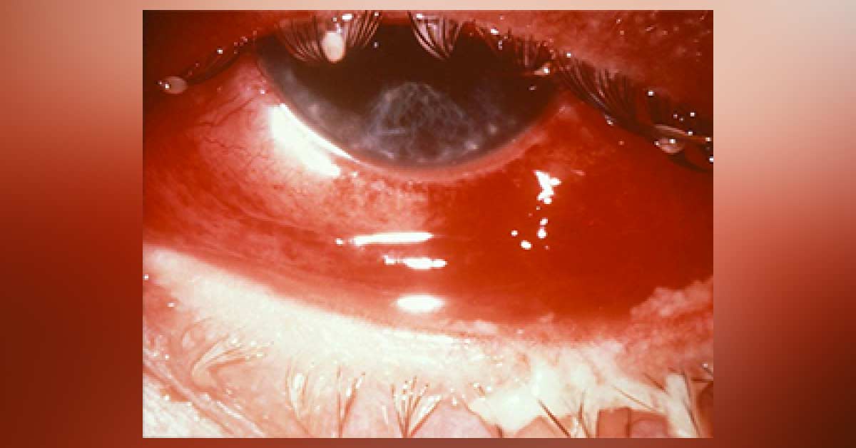 Green Discharge From Eye