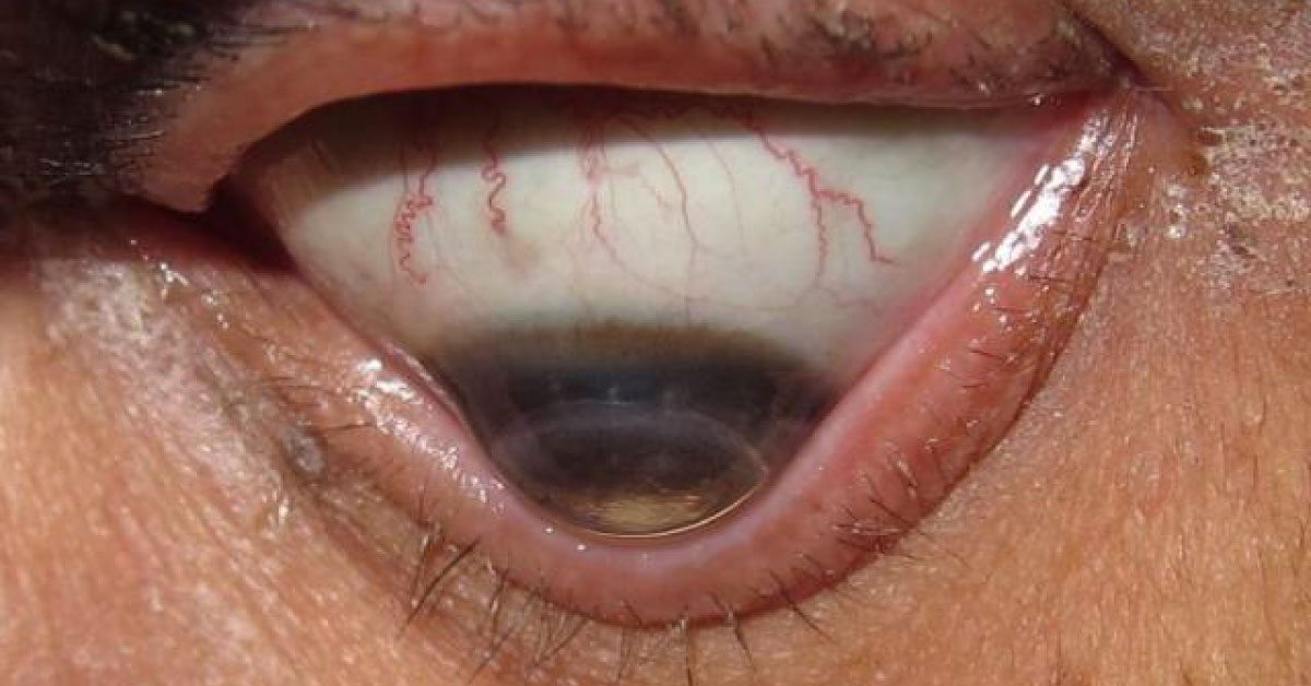 Brief Review On Keratoconus