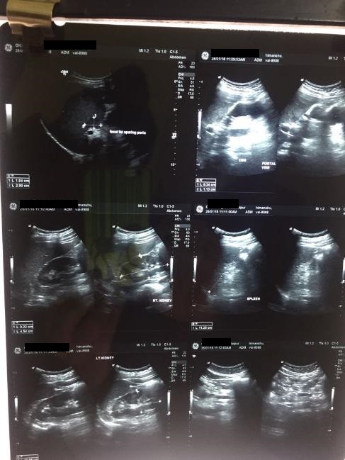What Is The Significance Of Fat Sparing Area In This Patient?