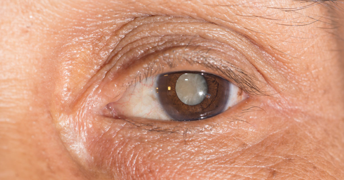 Brief Review On Low Tension Glaucoma
