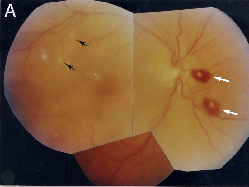 Very Brief Review Of Candidemia In Children