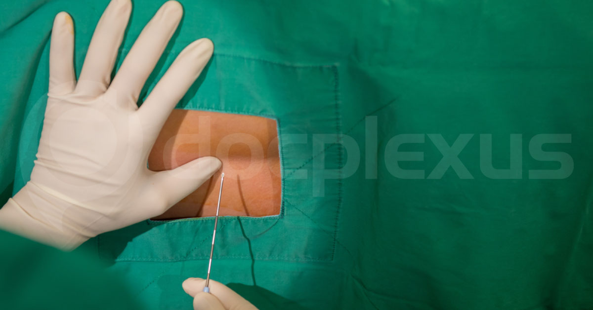 Preventing Deep Vein Thrombosis In Obese With Intrathecal Dexmedetomidine