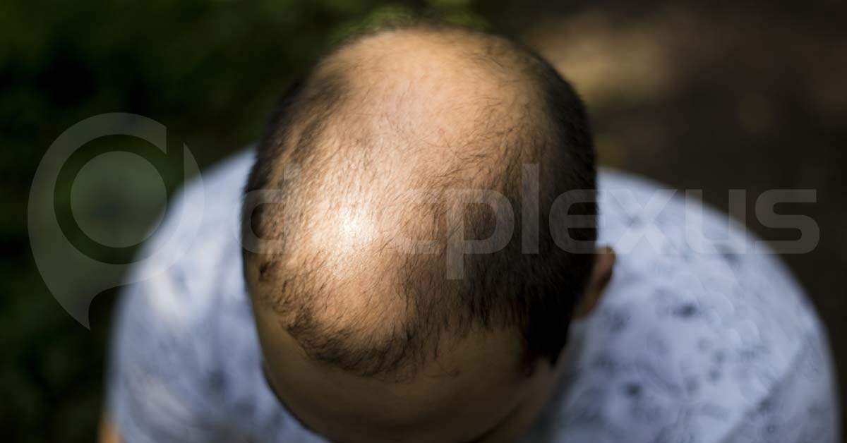 For Baldness Cure, Transplant Hairy Skin From Mouse Stem Cells: A Study