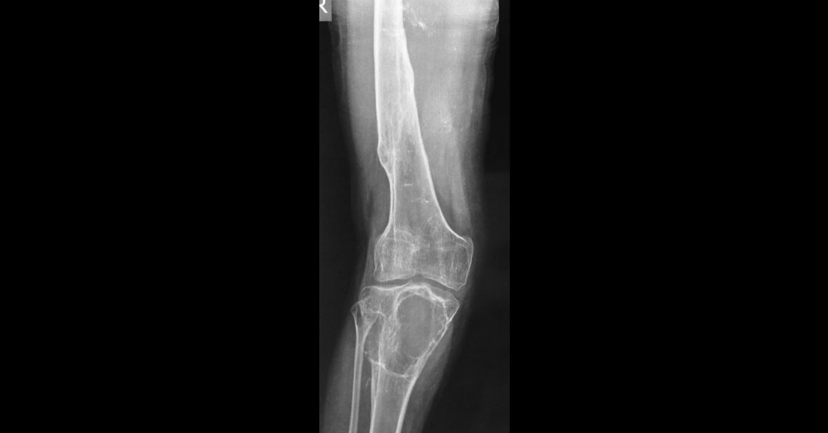 Male With Pain And Swelling In Right Knee