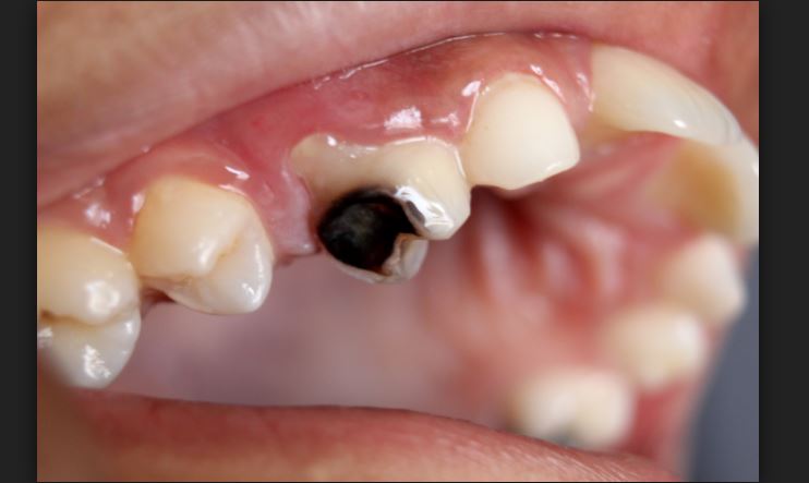 How Can Dentists Prevent Children Being Overweight?