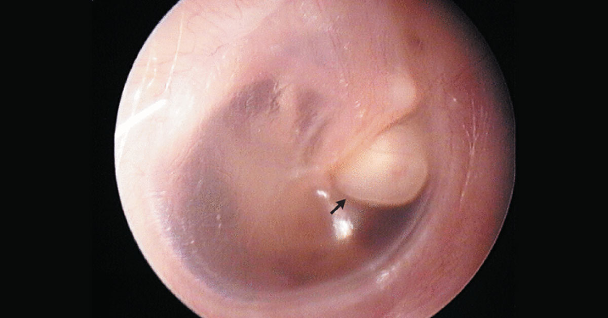 Subjective Hearing Loss In A Young Boy