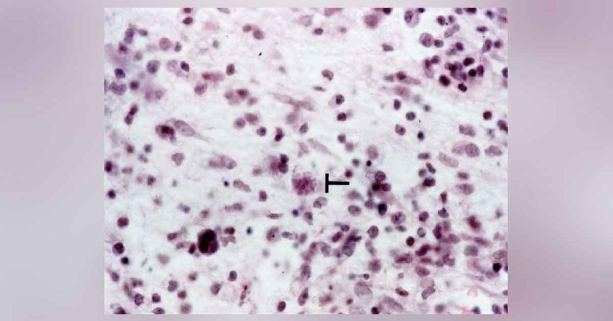 A Male With Necrotic Pontine Lesion