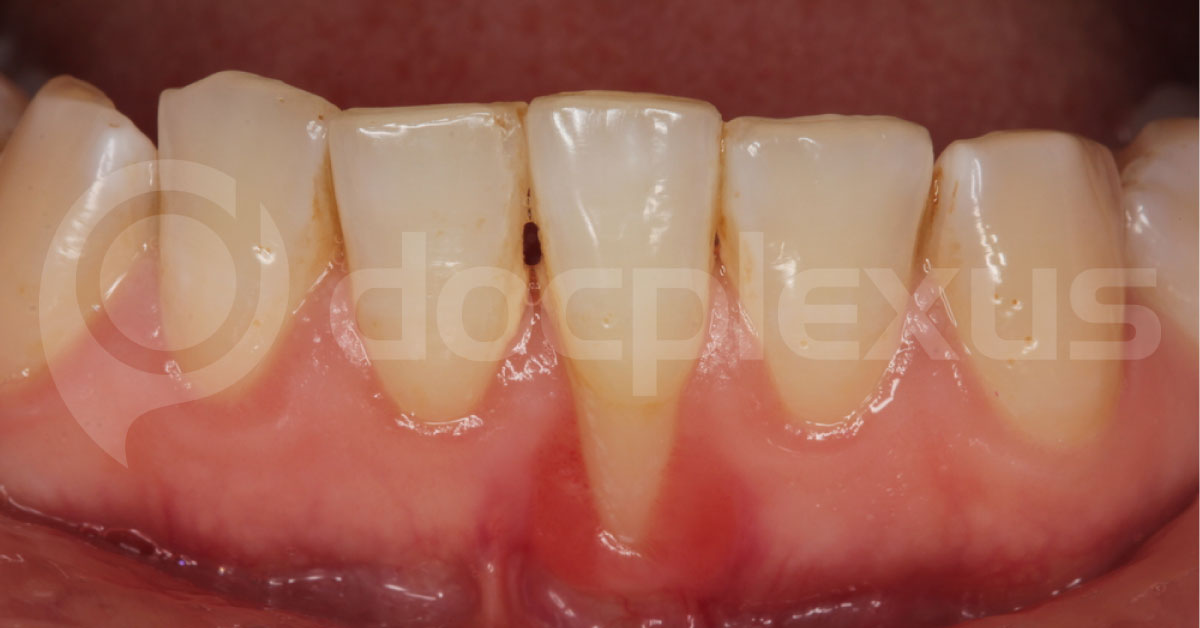 Overview of Gingivitis