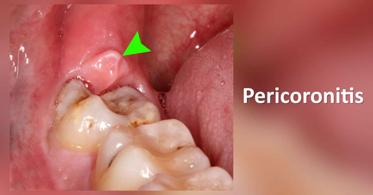 An Insight on Pericoronitis Management