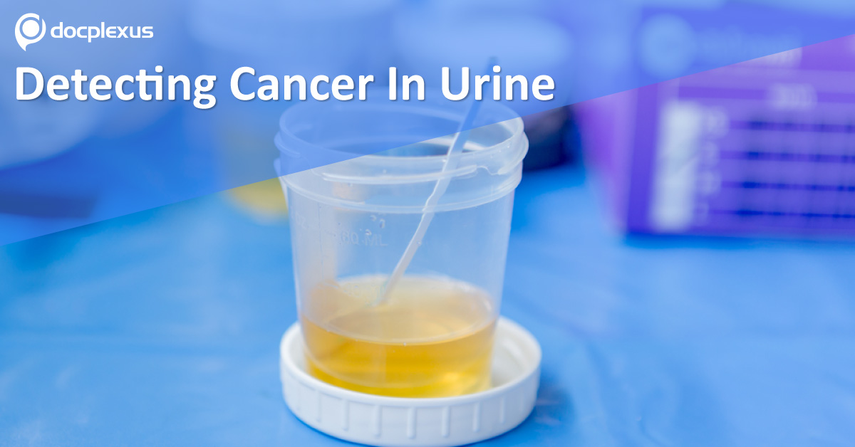 Now Doctors Can Diagnose Cancer In Simple Urine Test