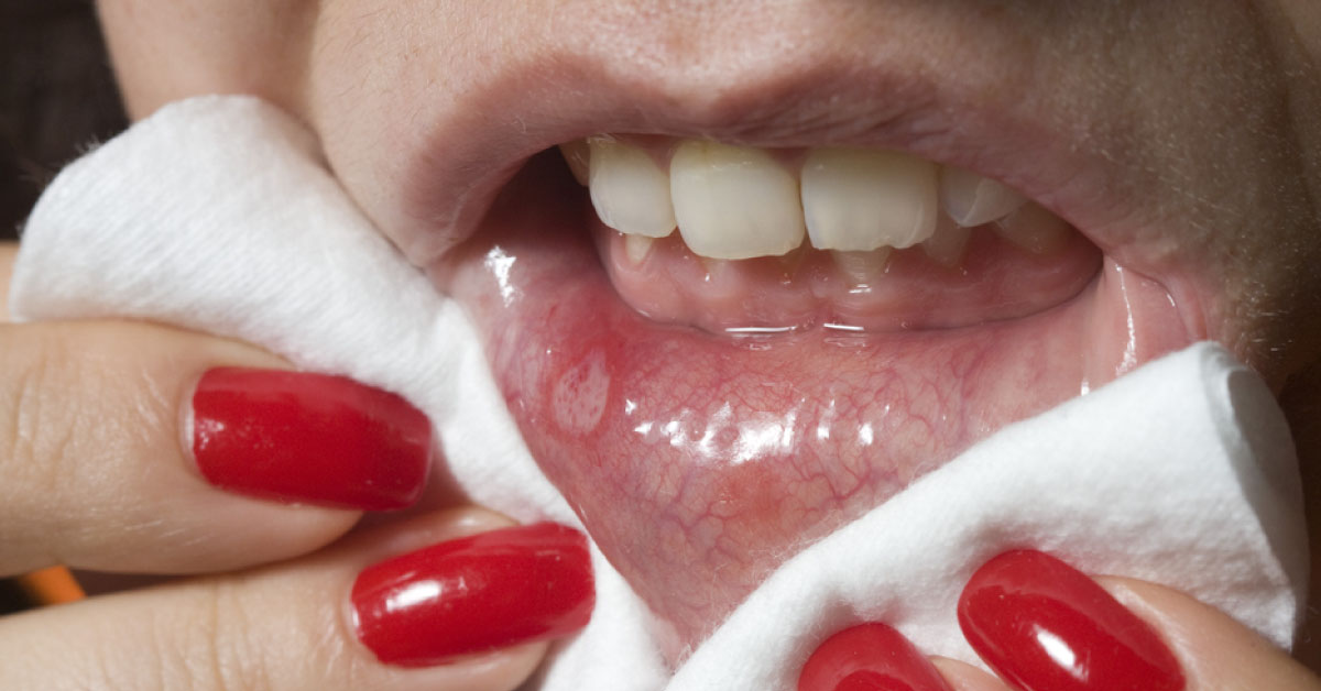 Spot This Oral Condition