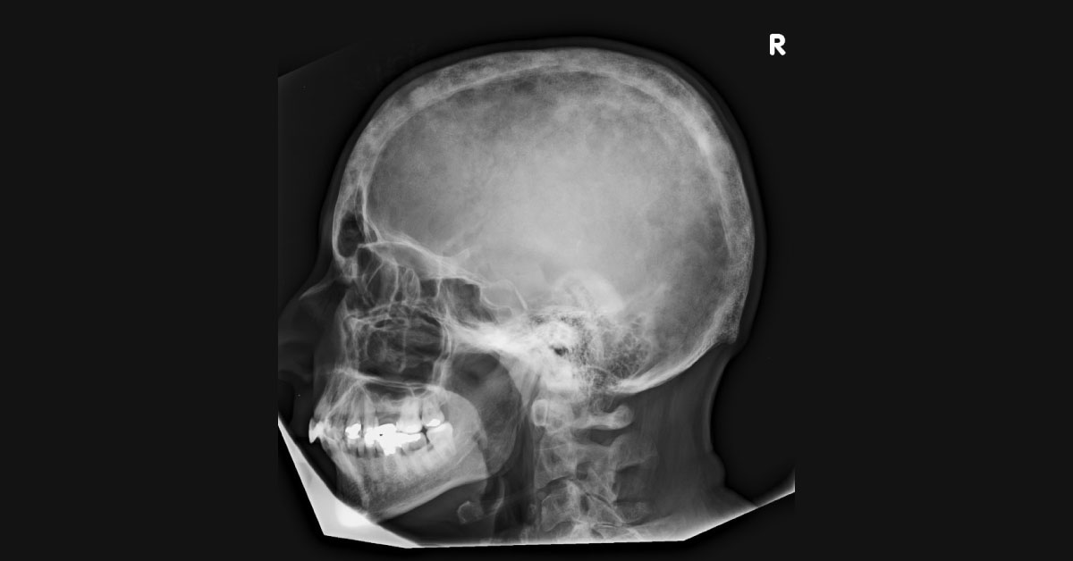 Spot This Bone Disorder