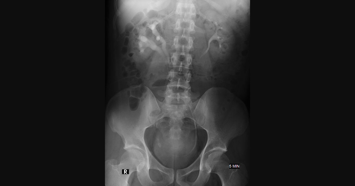Male With Several Episodes Of Right Ureteric Colic