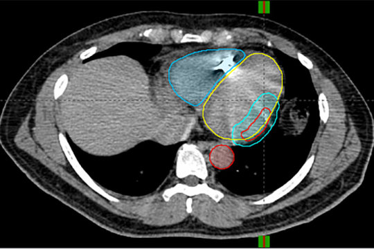 Radiation Therapy To Treat Unresponsive Heart Arrhythmia