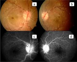 Brief Review On Multiple Sclerosis