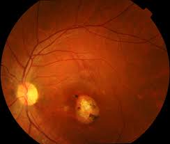 Brief Review On Ocular Manifestations Of Congenital Varicella Syndrome