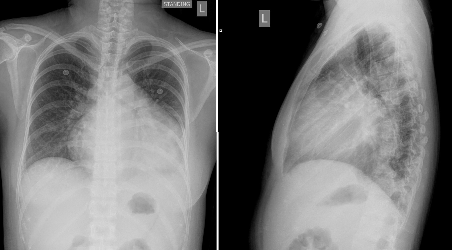 Acute Shortness Of Breath In A 26 Year Old Female