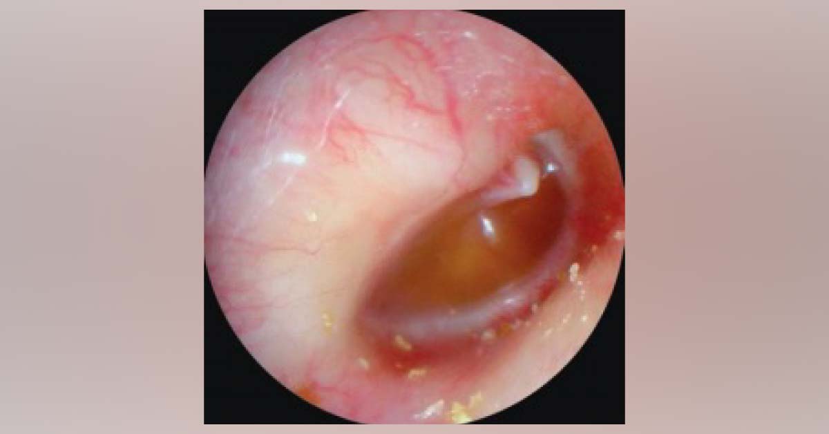 What Does This Otoendoscopic Examination Show?