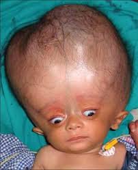 Brief Review On Hydrocephalus