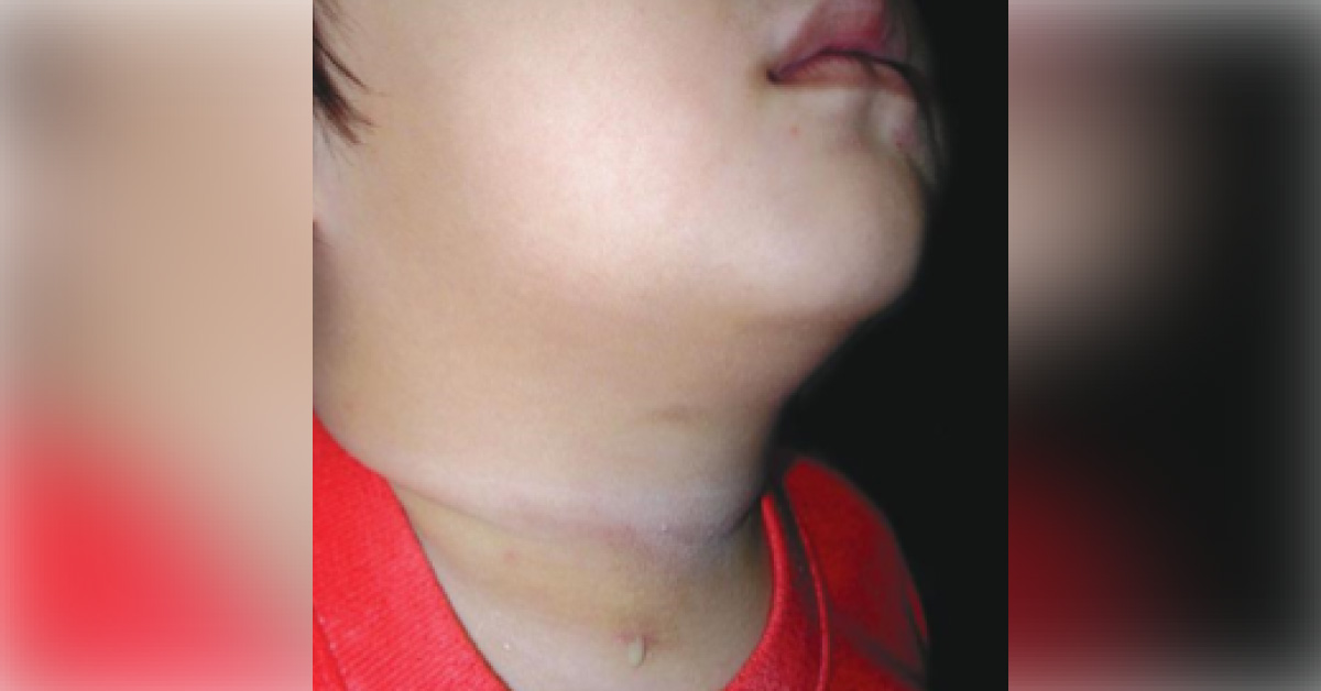 Purulent Discharge From Lower Neck