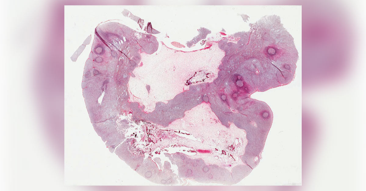 A Male With Well-Demarcated Parieto-Occipital Mass