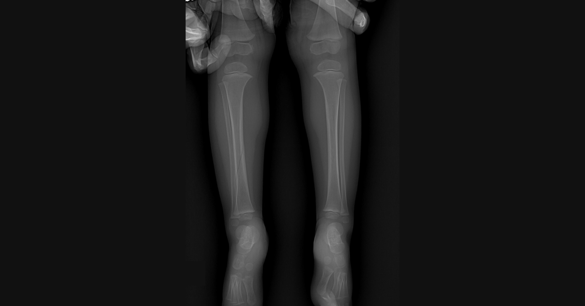 A One-year-old with a Swollen Calf