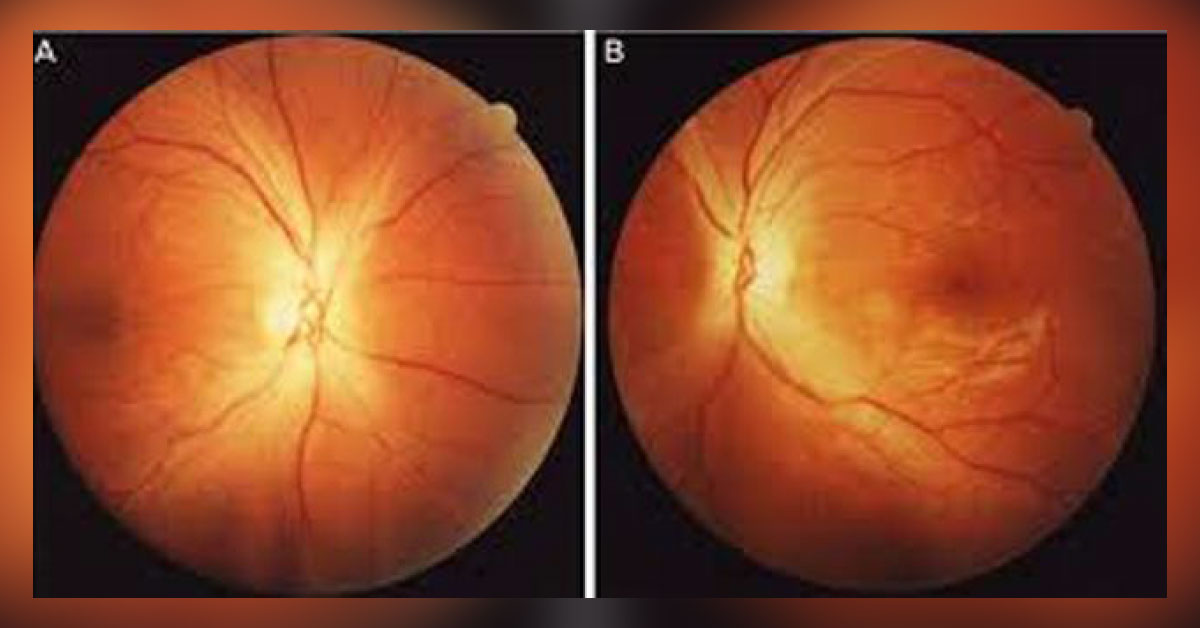 Brief Review On Ocular And Complications Of Acute Methyl Alcohol Intoxication