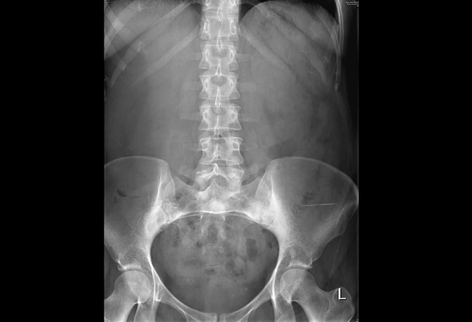 What Caused Acute Abdominal Pain In This Woman?