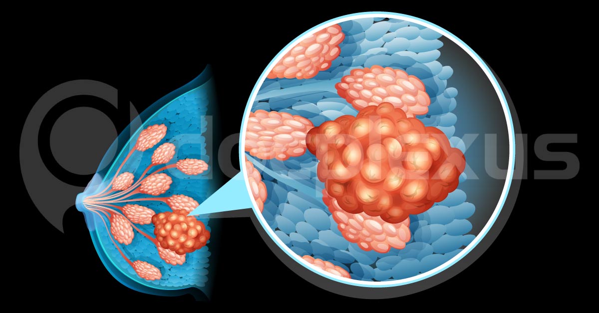 Which Anti-Neoplastic Drug Should Be Avoided?