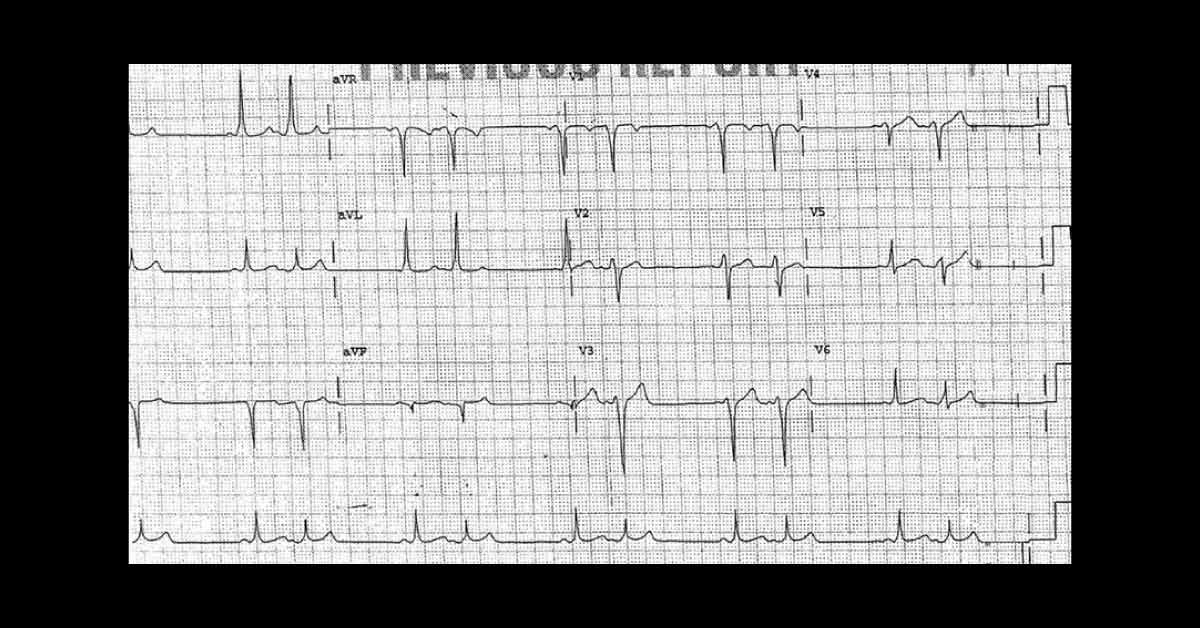 Irregular Heart Rhythm In Young Woman