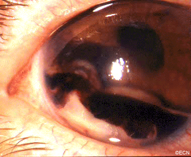 Brief Review On Ocular Manifestations Of Cancer