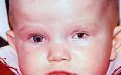Brief Review On Microphthalmos