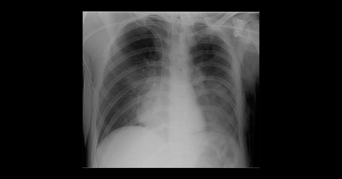Acute Respiratory Distress In ICU Patient