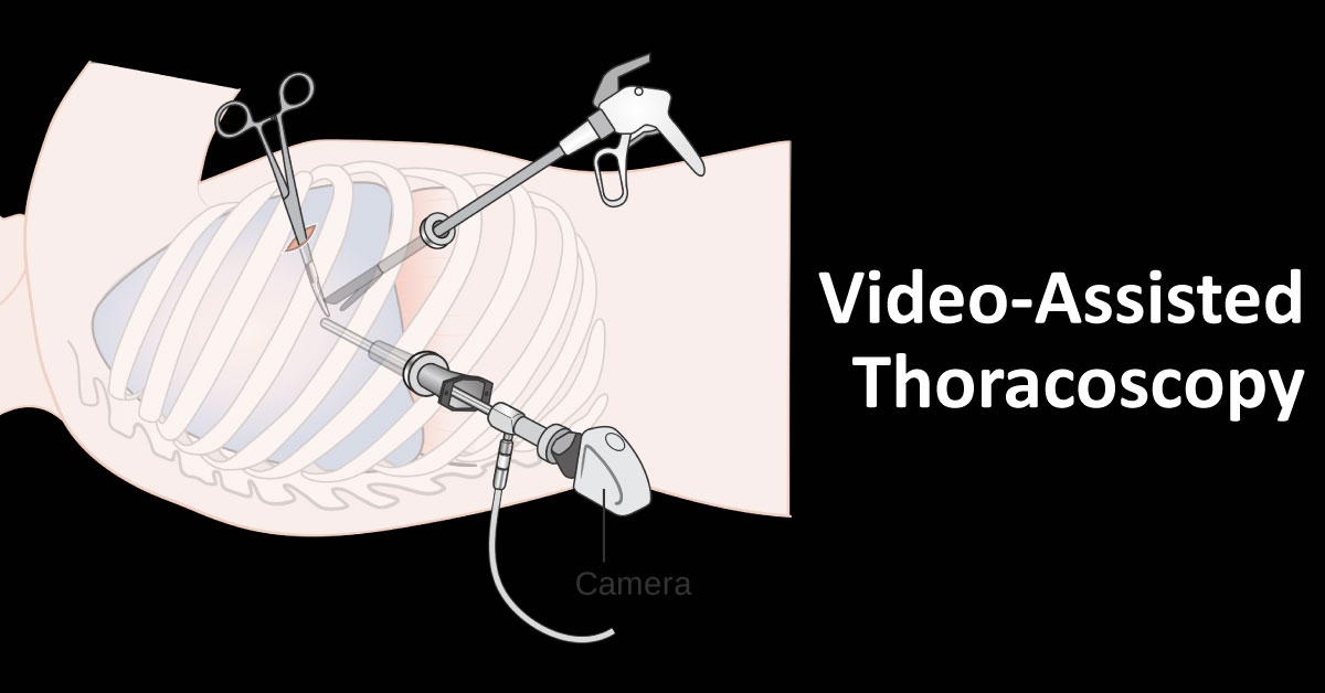 Suggest the Anesthesia Technique for Video-assisted Thoracoscopy
