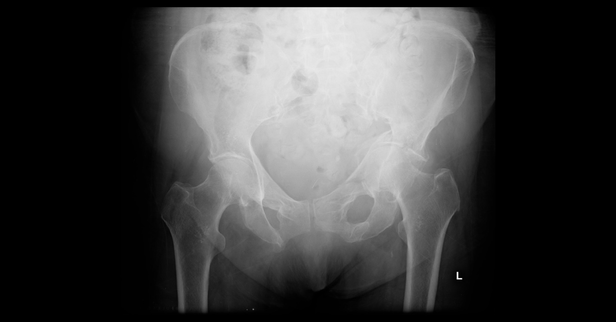Pelvic Pain In A 95-Year-Old Female