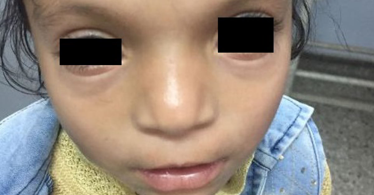 William's Syndrome Or Down's Syndrome? 