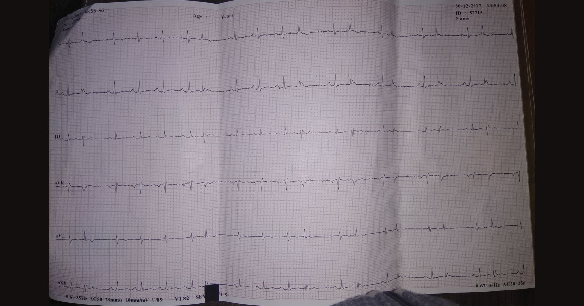 Diagnosis And Treatment Of ECG Of A Hypertensive