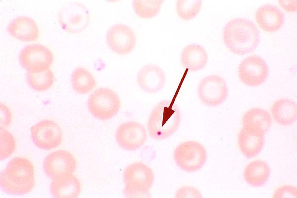Detect the Abnormality in This Blood Smear