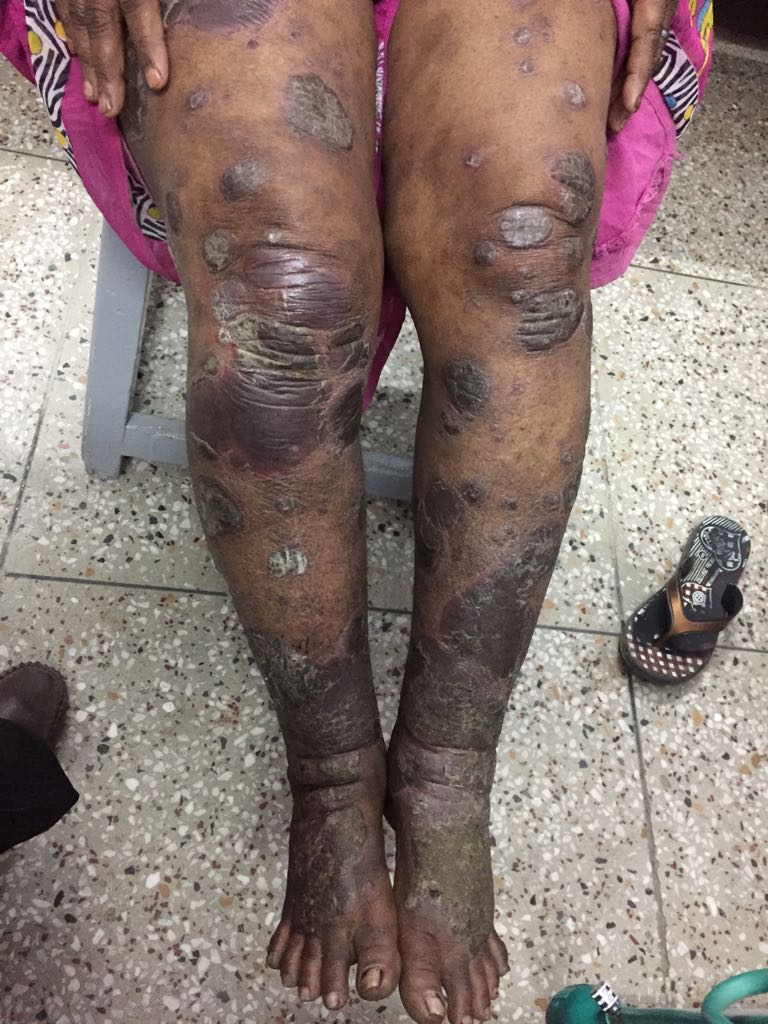 Extensive Psoriasis, Suggest Treatment? 