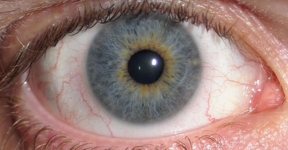 Brief Review On Amaurosis